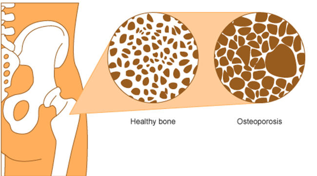 This figure shows the bone density of a healthy bone and one with osteoporosis. The one with osteoporosis has a much lower bone density.